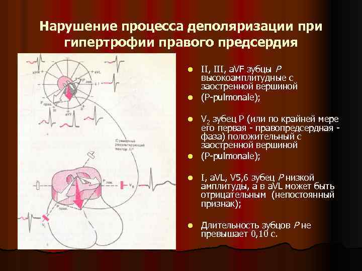 Нарушение процесса деполяризации при гипертрофии правого предсердия II, III, a. VF зубцы Р высокоамплитудные