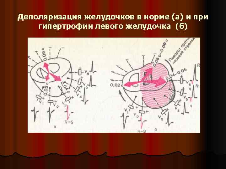 Деполяризация желудочков в норме (а) и при гипертрофии левого желудочка (б) 