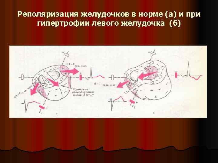 Реполяризация желудочков в норме (а) и при гипертрофии левого желудочка (б) 