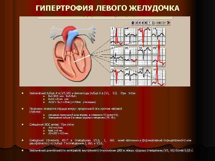 ГИПЕРТРОФИЯ ЛЕВОГО ЖЕЛУДОЧКА l Увеличение зубца R в (V 5, V 6) и амплитуды