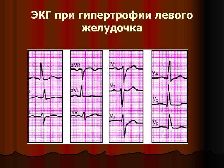 ЭКГ при гипертрофии левого желудочка 