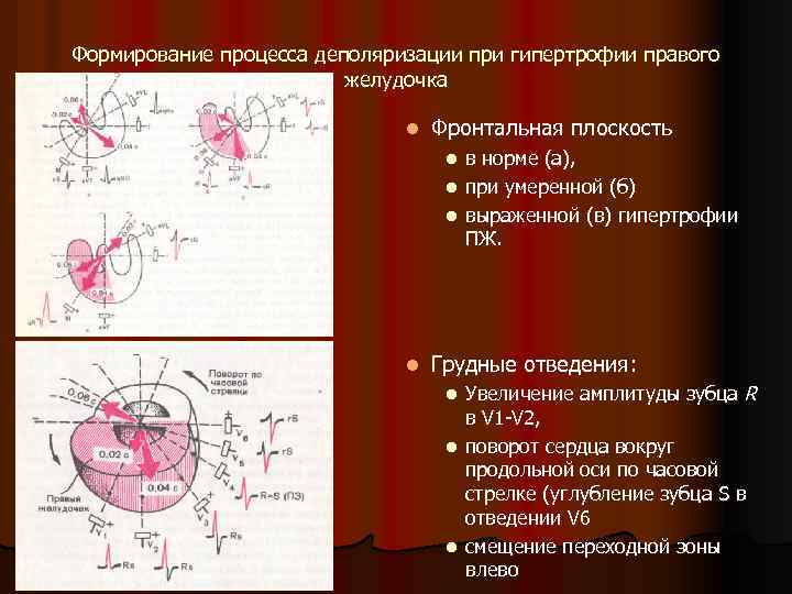 Формирование процесса деполяризации при гипертрофии правого желудочка l Фронтальная плоскость в норме (а), l