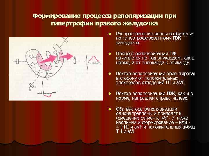 Формирование процесса реполяризации при гипертрофии правого желудочка l Распространение волны возбужения по гипертрофированному ПЖ