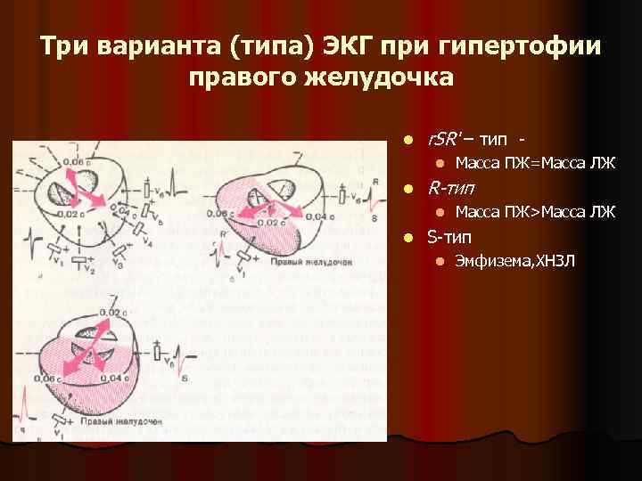 Три варианта (типа) ЭКГ при гипертофии правого желудочка l r. SR' – тип -