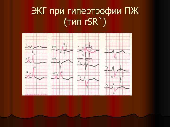 ЭКГ при гипертрофии ПЖ (тип r. SR`) 