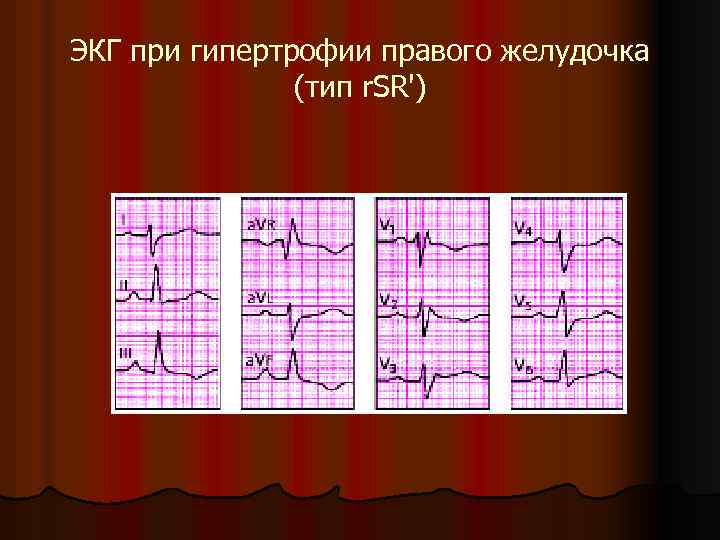 ЭКГ при гипертрофии правого желудочка (тип r. SR') 