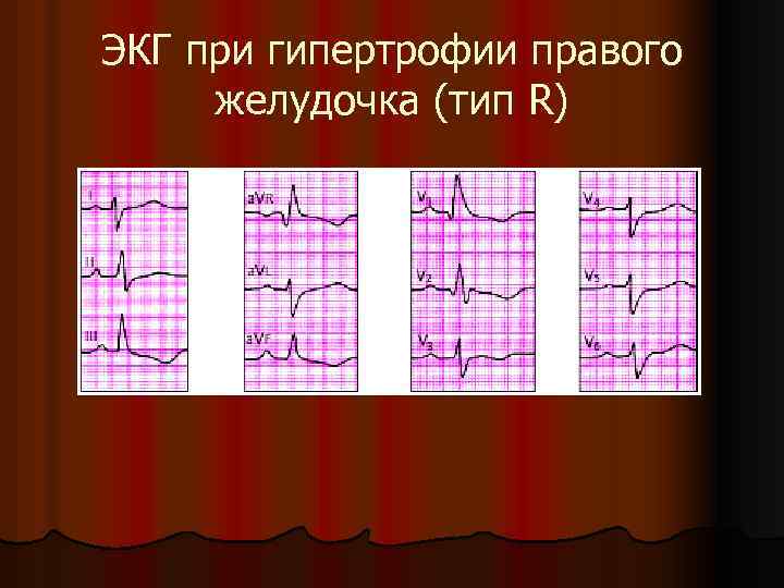 ЭКГ при гипертрофии правого желудочка (тип R) 