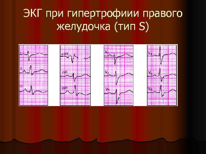 ЭКГ при гипертрофиии правого желудочка (тип S) 