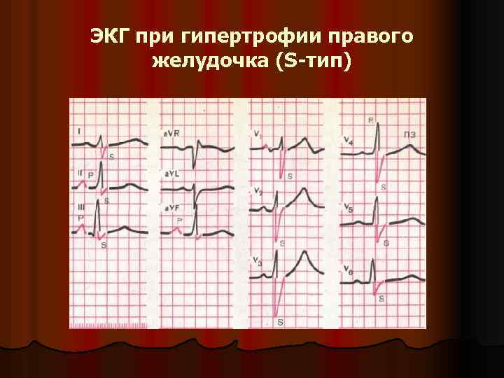 ЭКГ при гипертрофии правого желудочка (S-тип) 