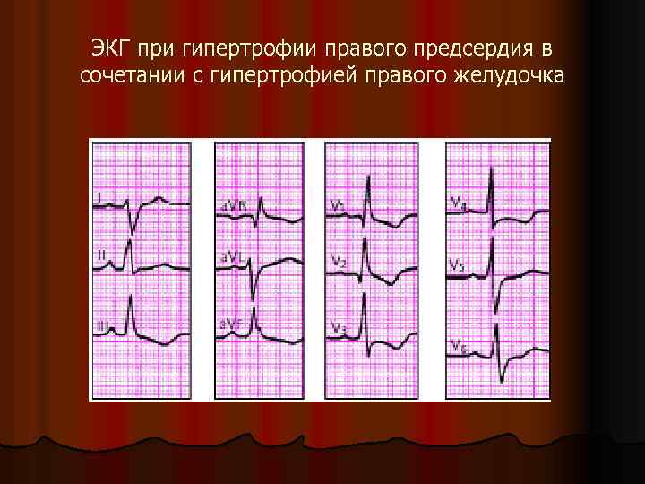 ЭКГ при гипертрофии правого предсердия в сочетании с гипертрофией правого желудочка 