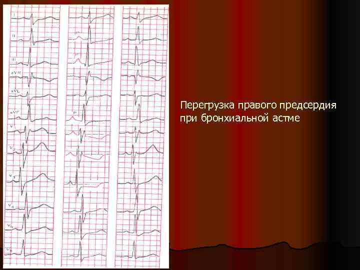 Перегрузка правого предсердия при бронхиальной астме 