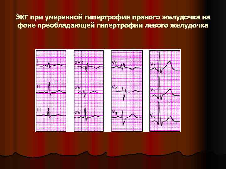 ЭКГ при умеренной гипертрофии правого желудочка на фоне преобладающей гипертрофии левого желудочка 