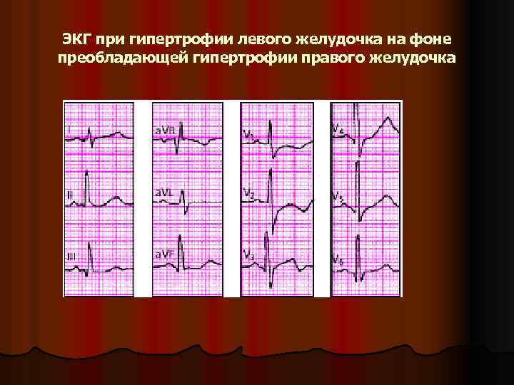 ЭКГ при гипертрофии левого желудочка на фоне преобладающей гипертрофии правого желудочка 