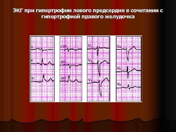 ЭКГ при гипертрофии левого предсердия в сочетании с гипертрофией правого желудочка 