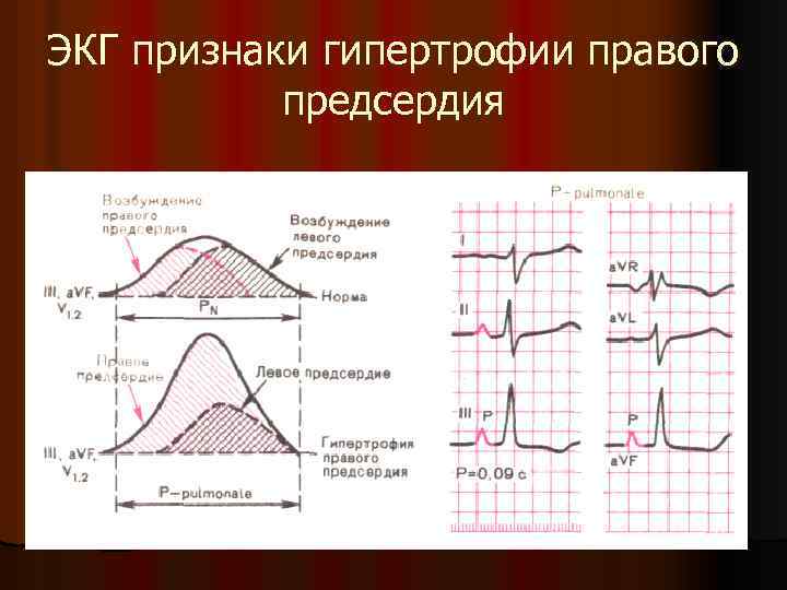 ЭКГ признаки гипертрофии правого предсердия 