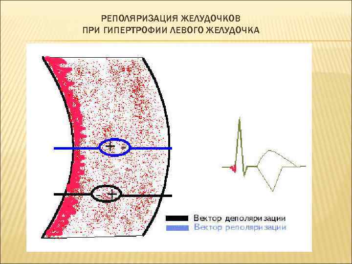 РЕПОЛЯРИЗАЦИЯ ЖЕЛУДОЧКОВ ПРИ ГИПЕРТРОФИИ ЛЕВОГО ЖЕЛУДОЧКА 