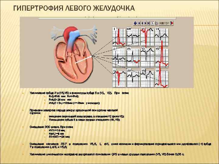 ГИПЕРТРОФИЯ ЛЕВОГО ЖЕЛУДОЧКА Увеличение зубца R в (V 5, V 6) и амплитуды зубца