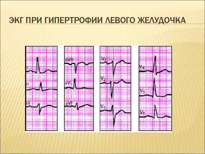 ЭКГ ПРИ ГИПЕРТРОФИИ ЛЕВОГО ЖЕЛУДОЧКА 