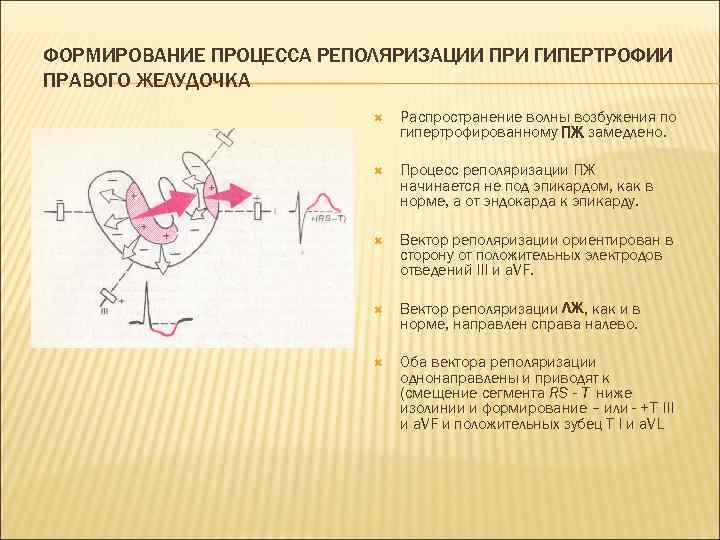 ФОРМИРОВАНИЕ ПРОЦЕССА РЕПОЛЯРИЗАЦИИ ПРИ ГИПЕРТРОФИИ ПРАВОГО ЖЕЛУДОЧКА Распространение волны возбужения по гипертрофированному ПЖ замедлено.