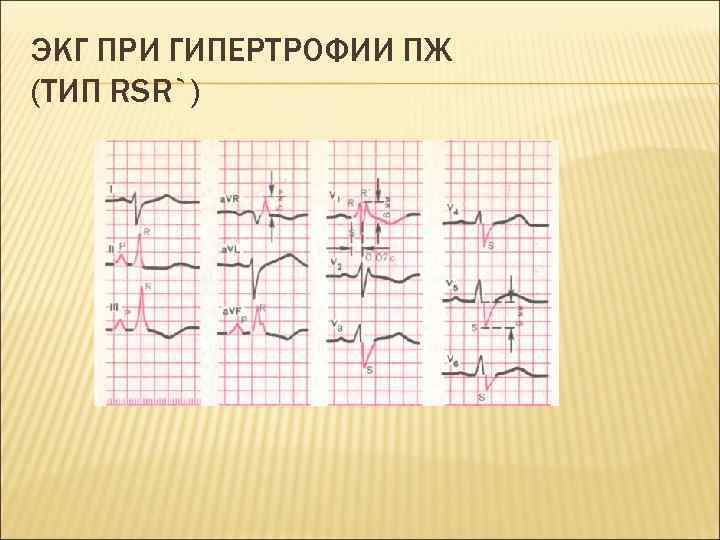 ЭКГ ПРИ ГИПЕРТРОФИИ ПЖ (ТИП RSR`) 