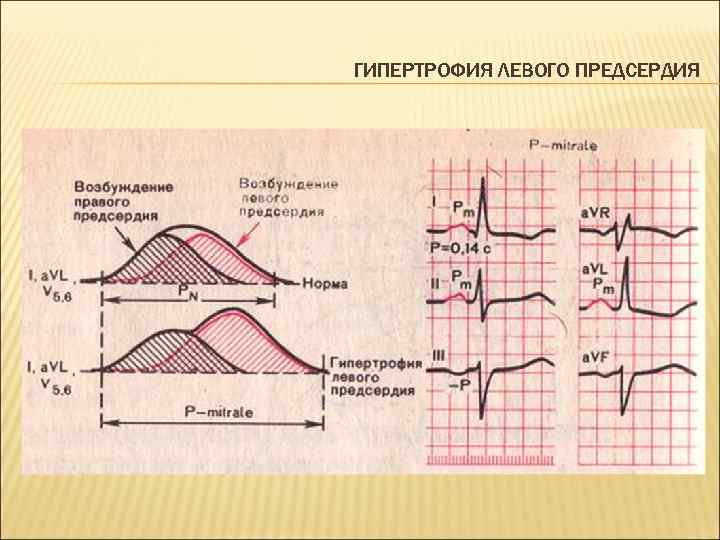 ГИПЕРТРОФИЯ ЛЕВОГО ПРЕДСЕРДИЯ 