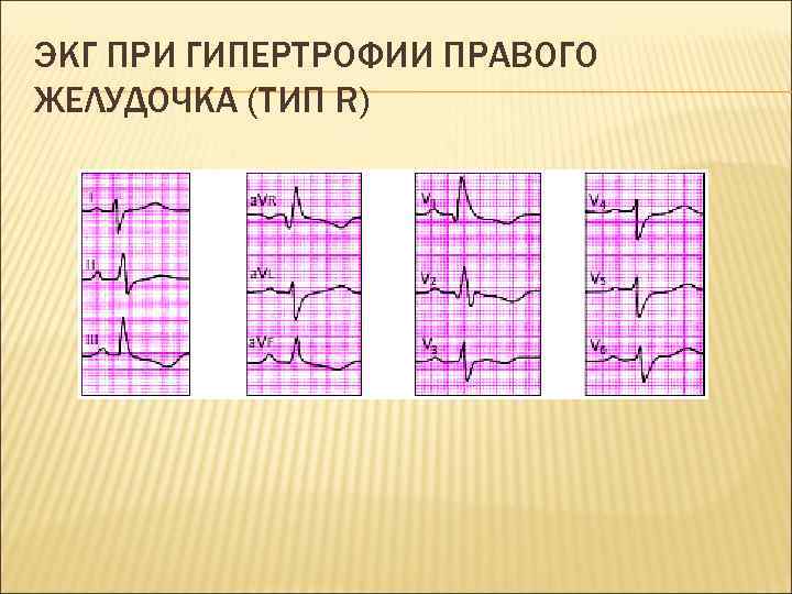 ЭКГ ПРИ ГИПЕРТРОФИИ ПРАВОГО ЖЕЛУДОЧКА (ТИП R) 