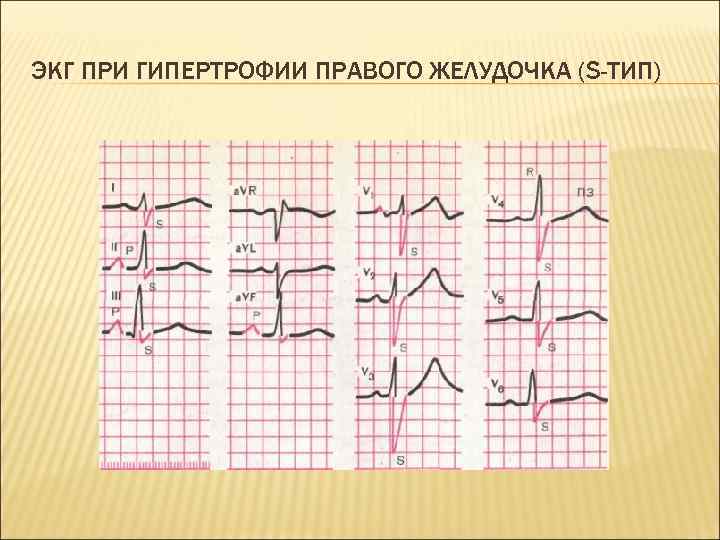 ЭКГ ПРИ ГИПЕРТРОФИИ ПРАВОГО ЖЕЛУДОЧКА (S-ТИП) 