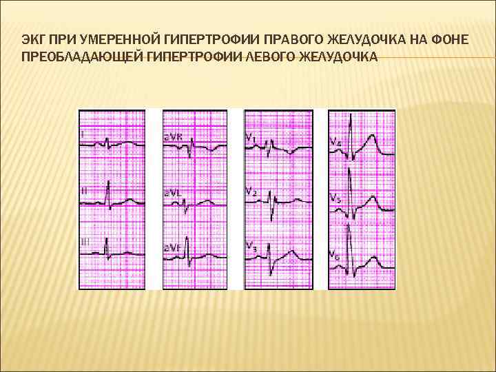 ЭКГ ПРИ УМЕРЕННОЙ ГИПЕРТРОФИИ ПРАВОГО ЖЕЛУДОЧКА НА ФОНЕ ПРЕОБЛАДАЮЩЕЙ ГИПЕРТРОФИИ ЛЕВОГО ЖЕЛУДОЧКА 