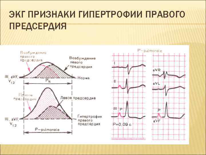 ЭКГ ПРИЗНАКИ ГИПЕРТРОФИИ ПРАВОГО ПРЕДСЕРДИЯ 