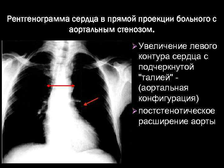 Рентгенограмма сердца в прямой проекции больного с аортальным стенозом. Ø Увеличение левого контура сердца