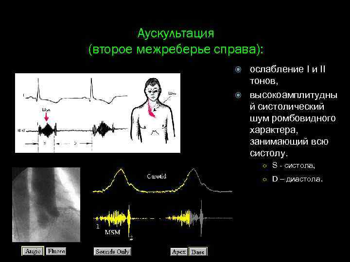 Аускультация (второе межреберье справа): ослабление I и II тонов, высокоамплитудны й систолический шум ромбовидного