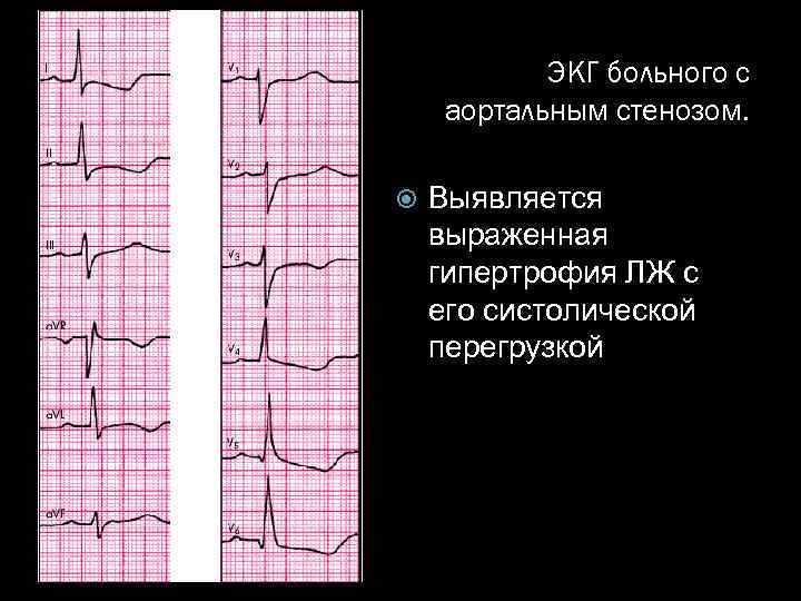 ЭКГ больного с аортальным стенозом. Выявляется выраженная гипертрофия ЛЖ с его систолической перегрузкой 