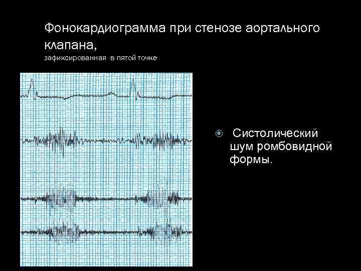 Фонокардиограмма при стенозе аортального клапана, зафиксированная в пятой точке Систолический шум ромбовидной формы. 