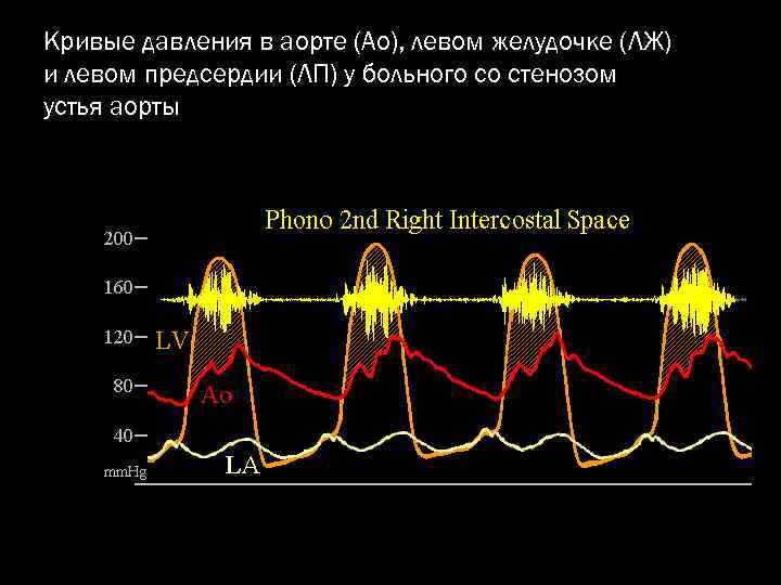 Кривые давления в аорте (Ао), левом желудочке (ЛЖ) и левом предсердии (ЛП) у больного