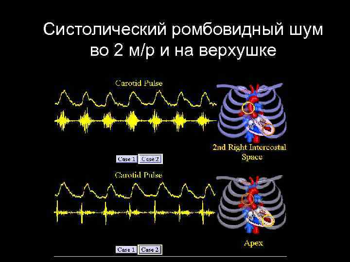 Систолический ромбовидный шум во 2 м/р и на верхушке 