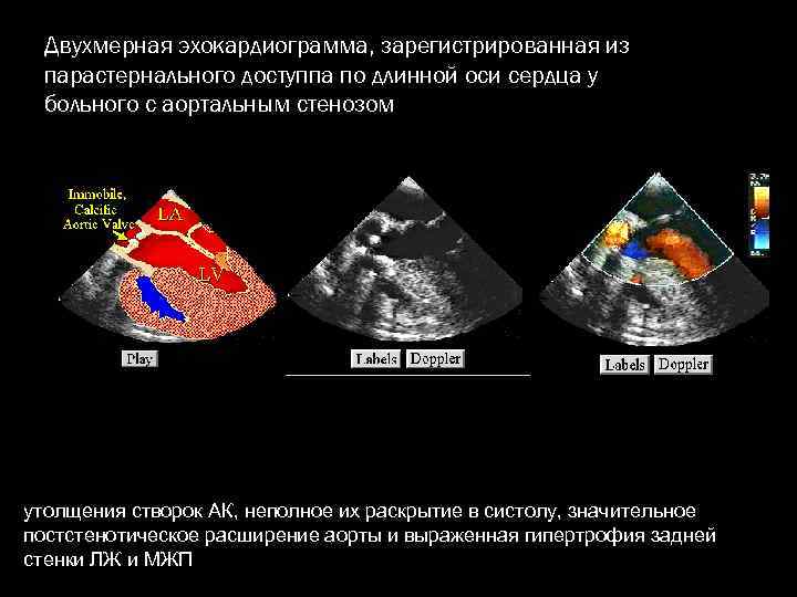 Двухмерная эхокардиограмма, зарегистрированная из парастернального доступпа по длинной оси сердца у больного с аортальным