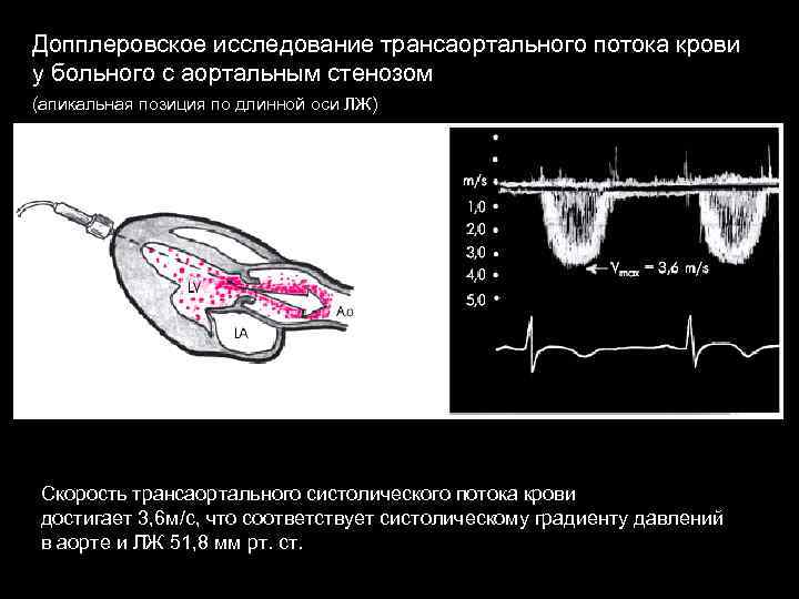 Допплеровское исследование трансаортального потока крови у больного с аортальным стенозом (апикальная позиция по длинной