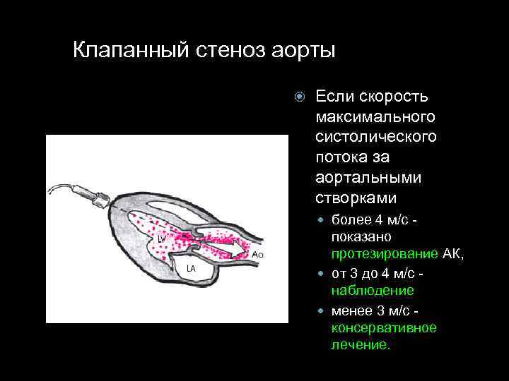 Клапанный стеноз аорты Если скорость максимального систолического потока за аортальными створками более 4 м/с