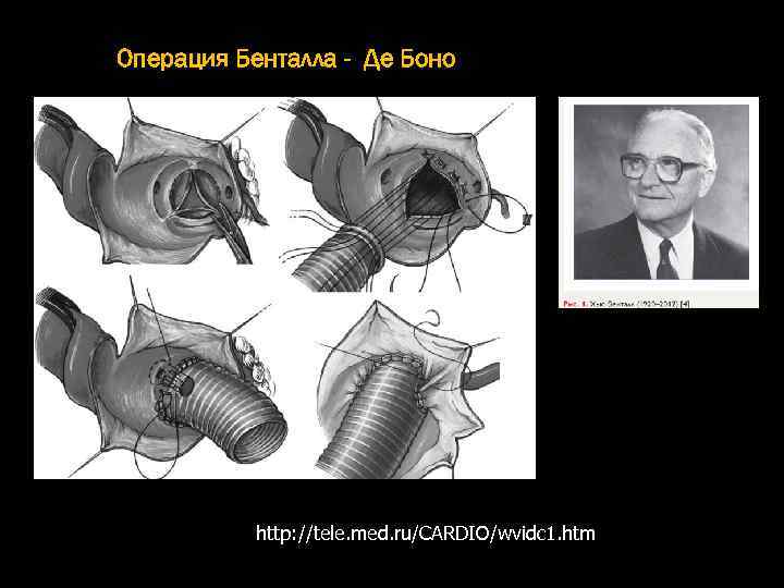 Операция Бенталла - Де Боно http: //tele. med. ru/CARDIO/wvidc 1. htm 