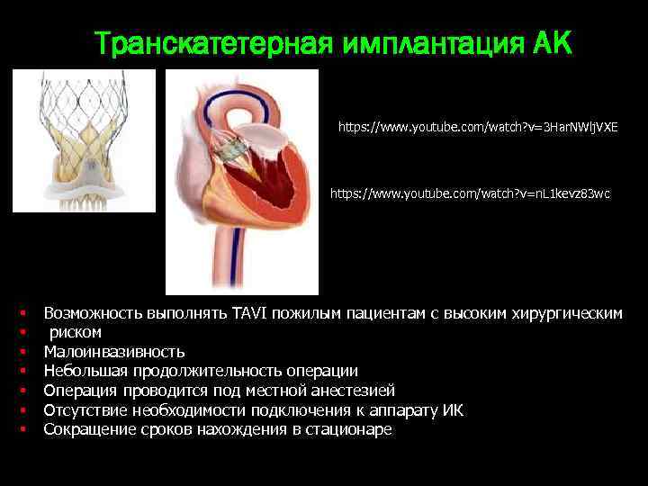 Транскатетерная имплантация АК https: //www. youtube. com/watch? v=3 Har. NWlj. VXE https: //www. youtube.