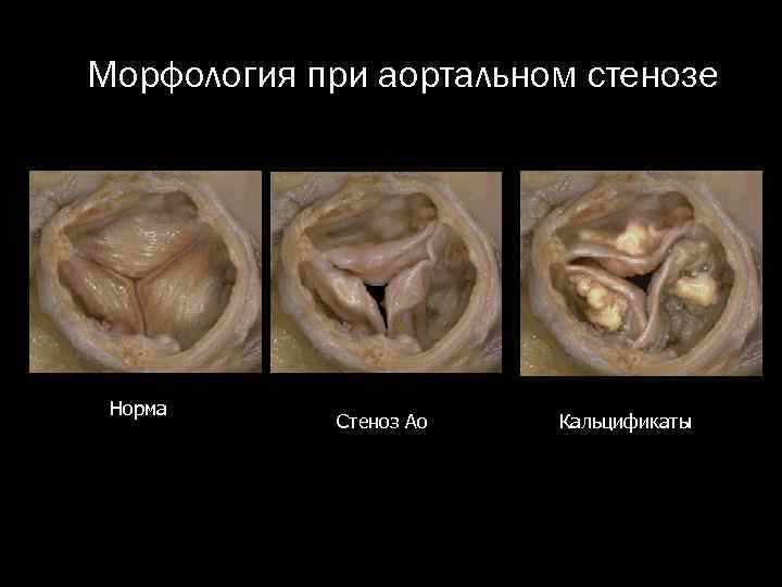 Морфология при аортальном стенозе Норма Стеноз Ао Кальцификаты 