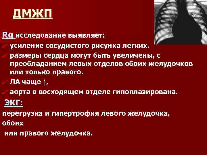 ДМЖП Rg исследование выявляет: усиление сосудистого рисунка легких. # размеры сердца могут быть увеличены,