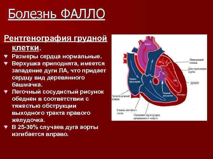 Врожденные пороки сердца презентация по педиатрии