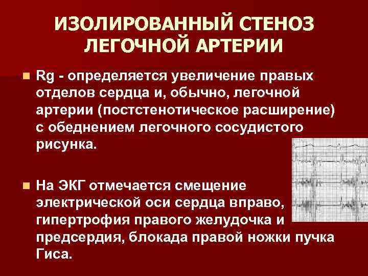 ИЗОЛИРОВАННЫЙ СТЕНОЗ ЛЕГОЧНОЙ АРТЕРИИ n Rg определяется увеличение правых отделов сердца и, обычно, легочной