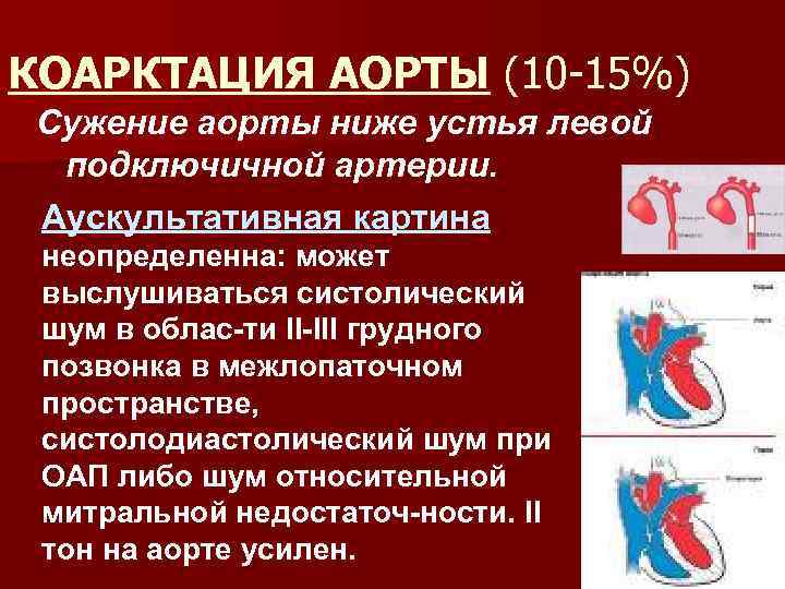 КОАРКТАЦИЯ АОРТЫ (10 -15%) Сужение аорты ниже устья левой подключичной артерии. Аускультативная картина неопределенна: