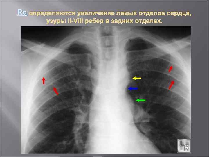 Rg определяются увеличение левых отделов сердца, узуры II VIII ребер в задних отделах. 