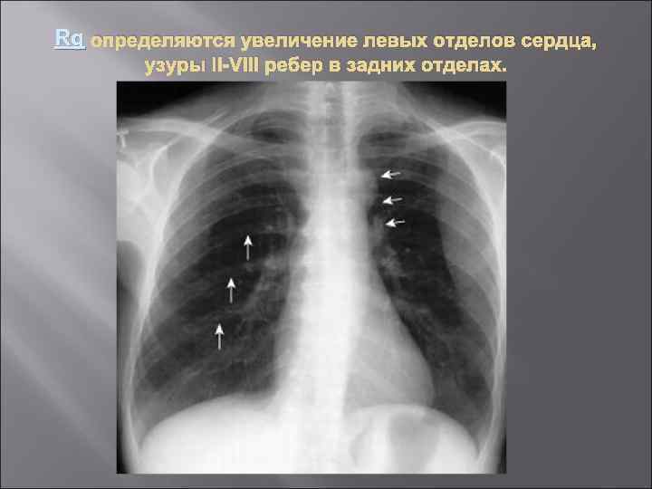 Rg определяются увеличение левых отделов сердца, узуры II VIII ребер в задних отделах. 