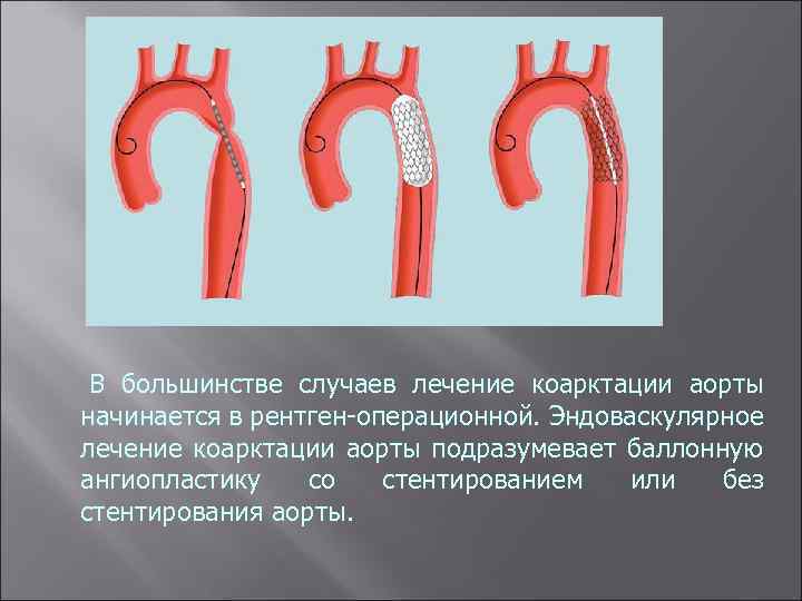  В большинстве случаев лечение коарктации аорты начинается в рентген-операционной. Эндоваскулярное лечение коарктации аорты