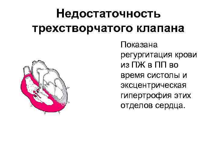 Недостаточность трехстворчатого клапана Показана регургитация крови из ПЖ в ПП во время систолы и