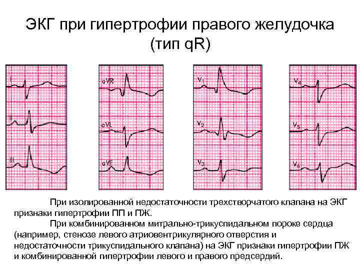 ЭКГ при гипертрофии правого желудочка (тип q. R) При изолированной недостаточности трехстворчатого клапана на